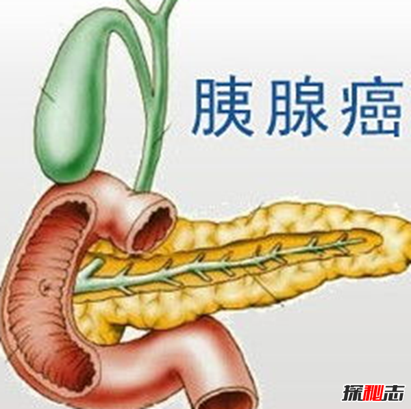 胰腺癌發(fā)病率最高的十大國家 無中國,日本榜上第七