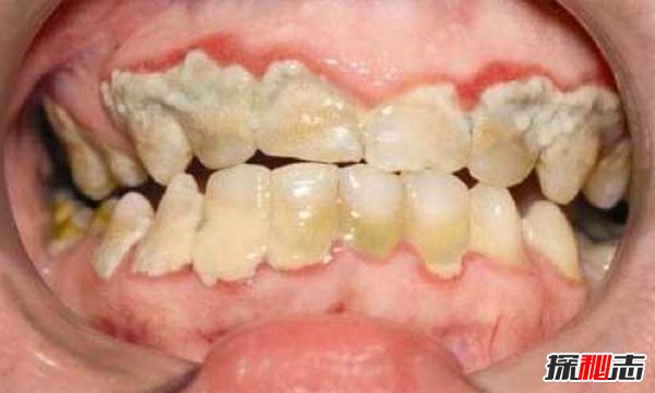 缺乏維生素會(huì)得什么病?不同維生素缺乏的十大癥狀