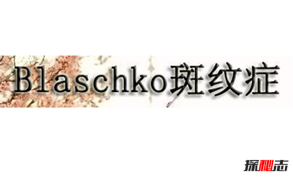 Blaschko斑紋癥是什么?全身長(zhǎng)滿條紋的罕見(jiàn)怪病
